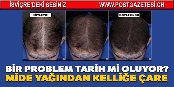 Bir problem tarih mi oluyor? Mide yağından kelliğe çare