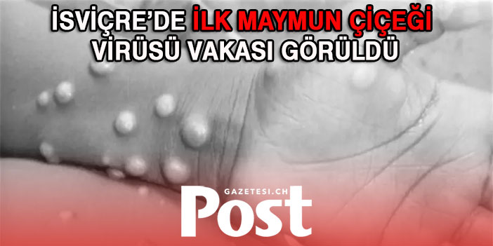 İSVİÇRE’DE İLK MAYMUN ÇİÇEĞİ VİRÜSÜ VAKASI