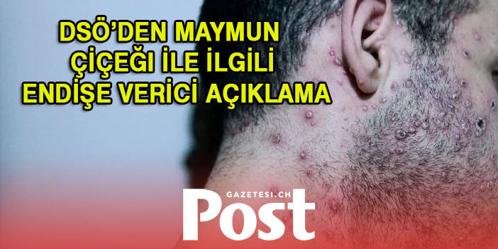 DSÖ’den maymun çiçeği salgını ile ilgili endişe yaratan açıklama