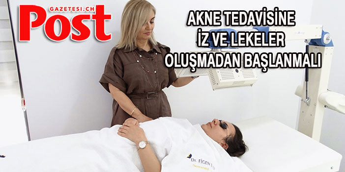 Akne Lekesi Kalmasın İstiyorsanız