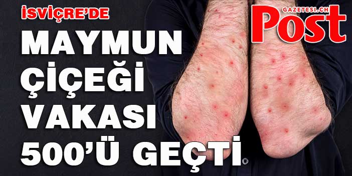 İsviçre’de Maymun Çiçeği vakaları 500 ü geçti