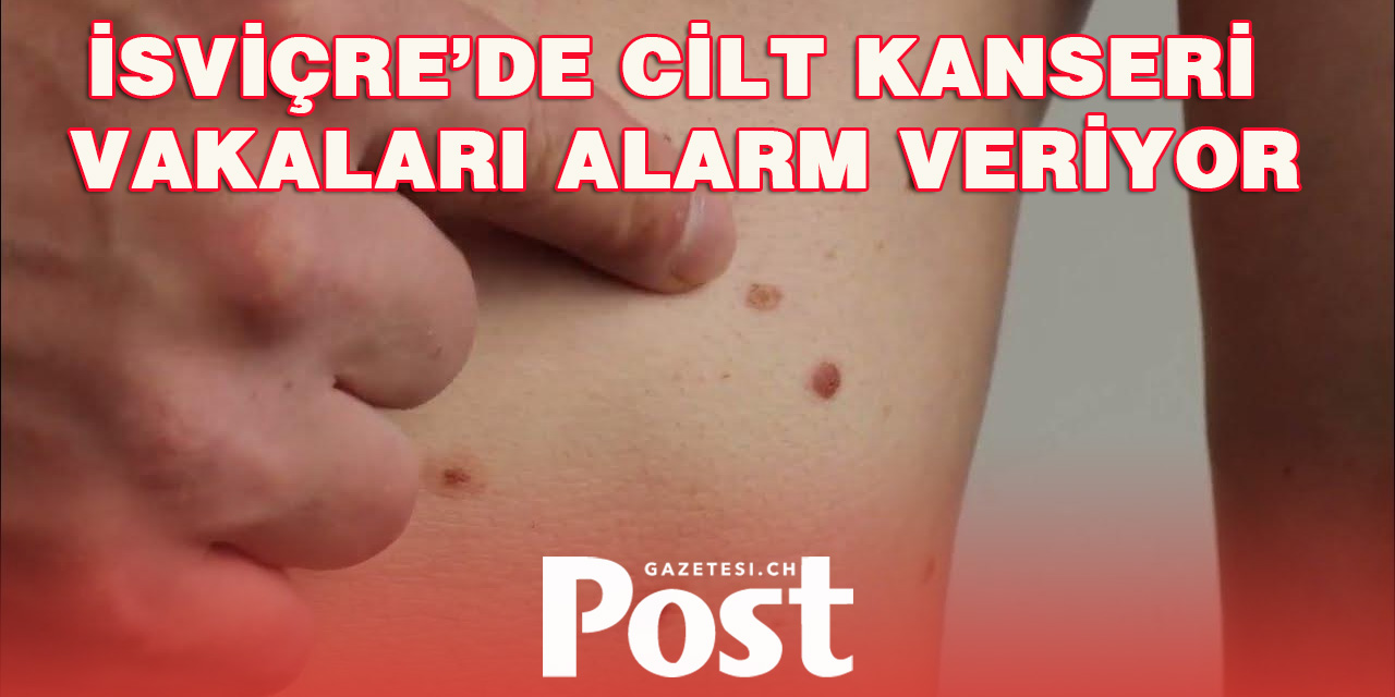 İsviçre’de Cilt Kanseri Riski Yüksek